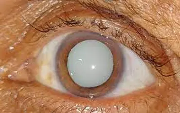 cataract surgery
