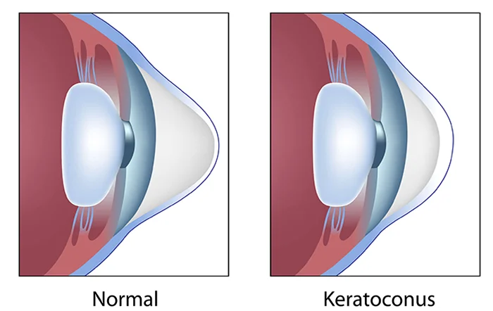Normal eye versus corneal disease comparison showing healthy and affected