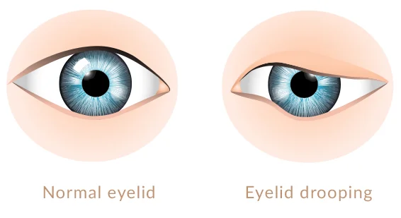 Medical diagram comparing normal eyelid to ptosis drooping condition
