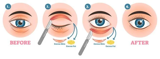 Oculoplasty surgery before and after results medical comparison diagram