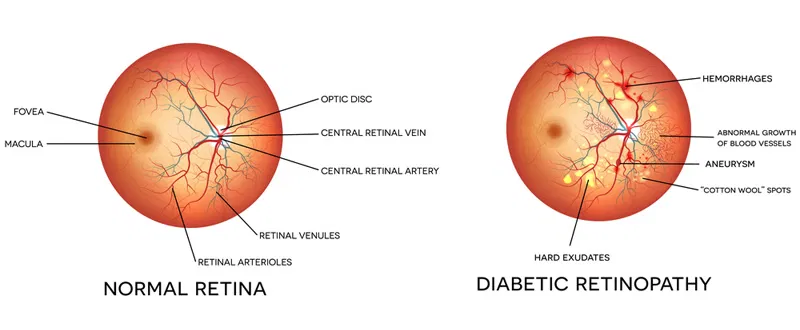 Comparison illustration of healthy retina and diabetic retinopathy