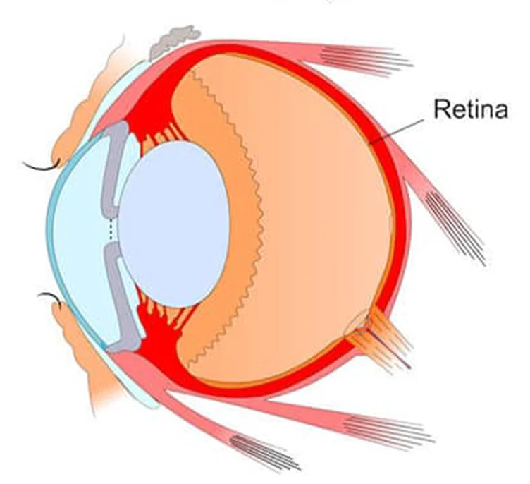 Specialized retinal diseases treatment and diagnosis options