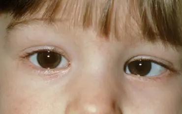Squint eye condition affecting vision alignment treatment
