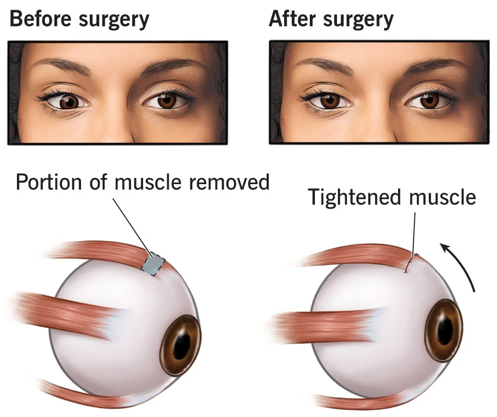 Squint vision before and after surgery comparison showing treatment results