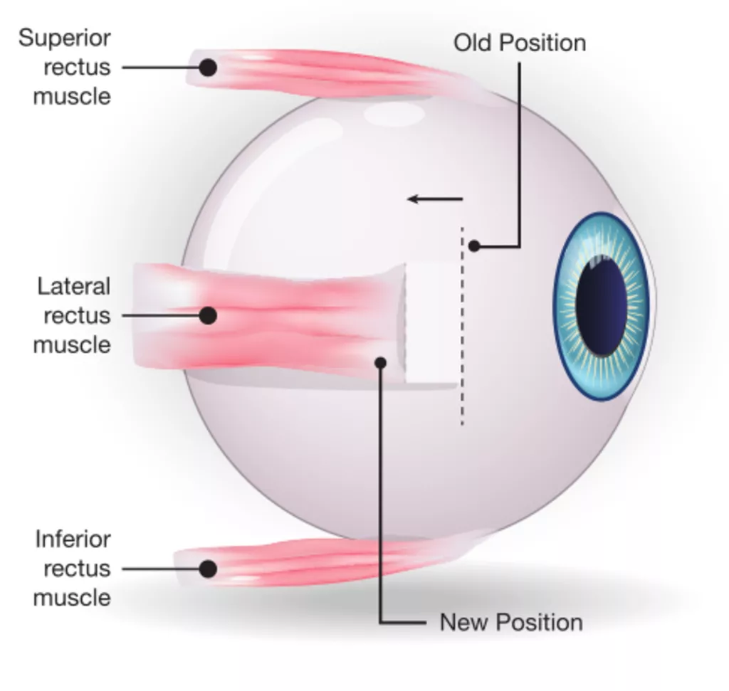 Pediatric squint eye surgery illustration demonstrating surgical correction procedure