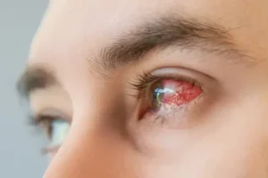 keratitis is corneal inflammation Corneal Diseases